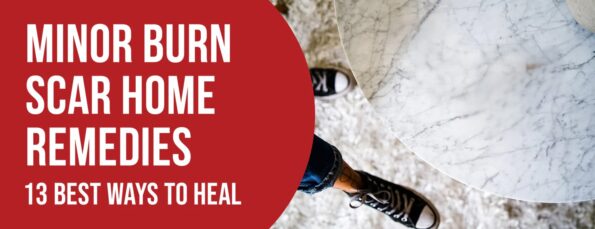 13 Home Remedies Minor Burn Scars