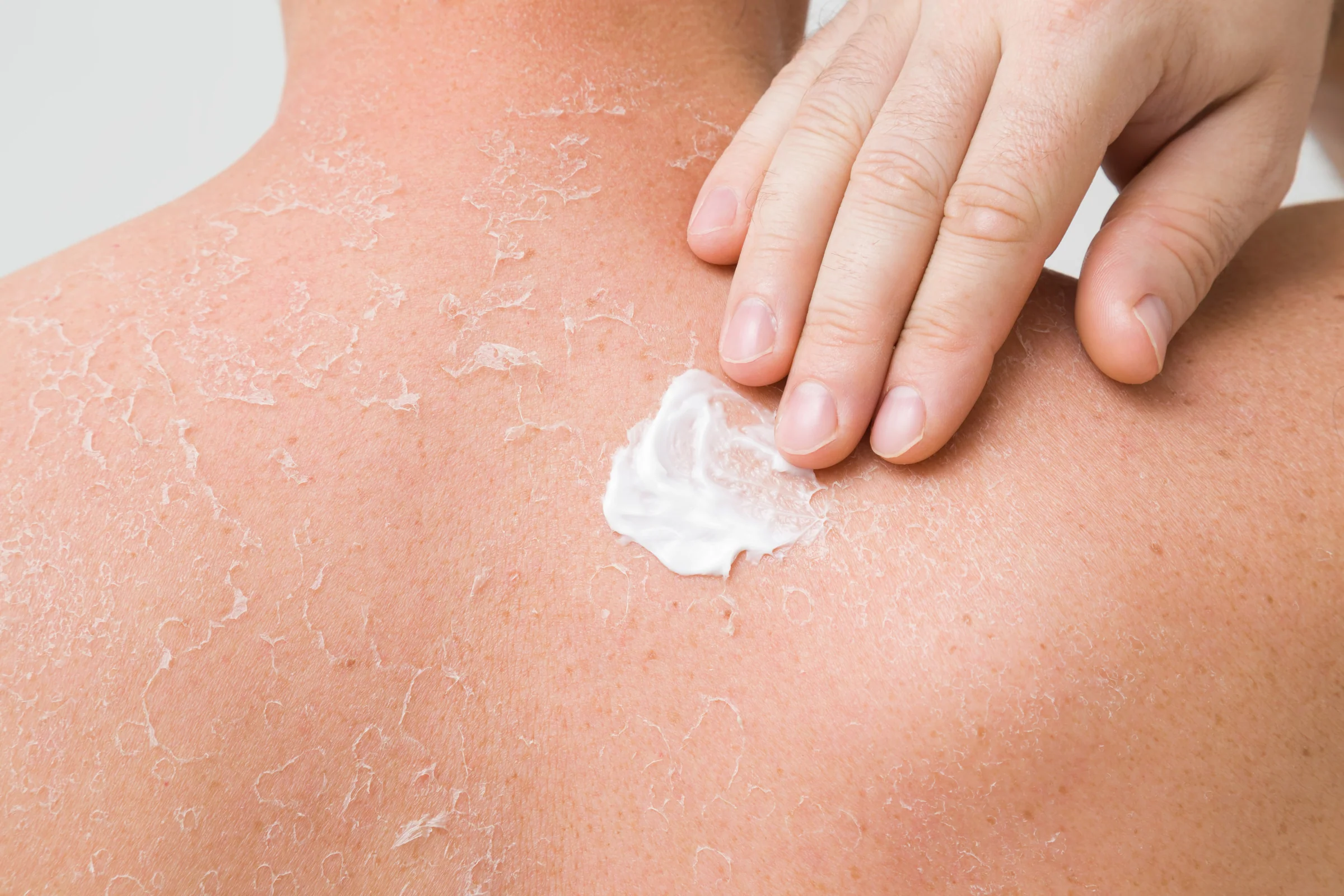 15 Tips for treating extreme sunburns