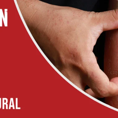 Fiberglass Skin Irritation: 8 Reasons & 2 Treatments