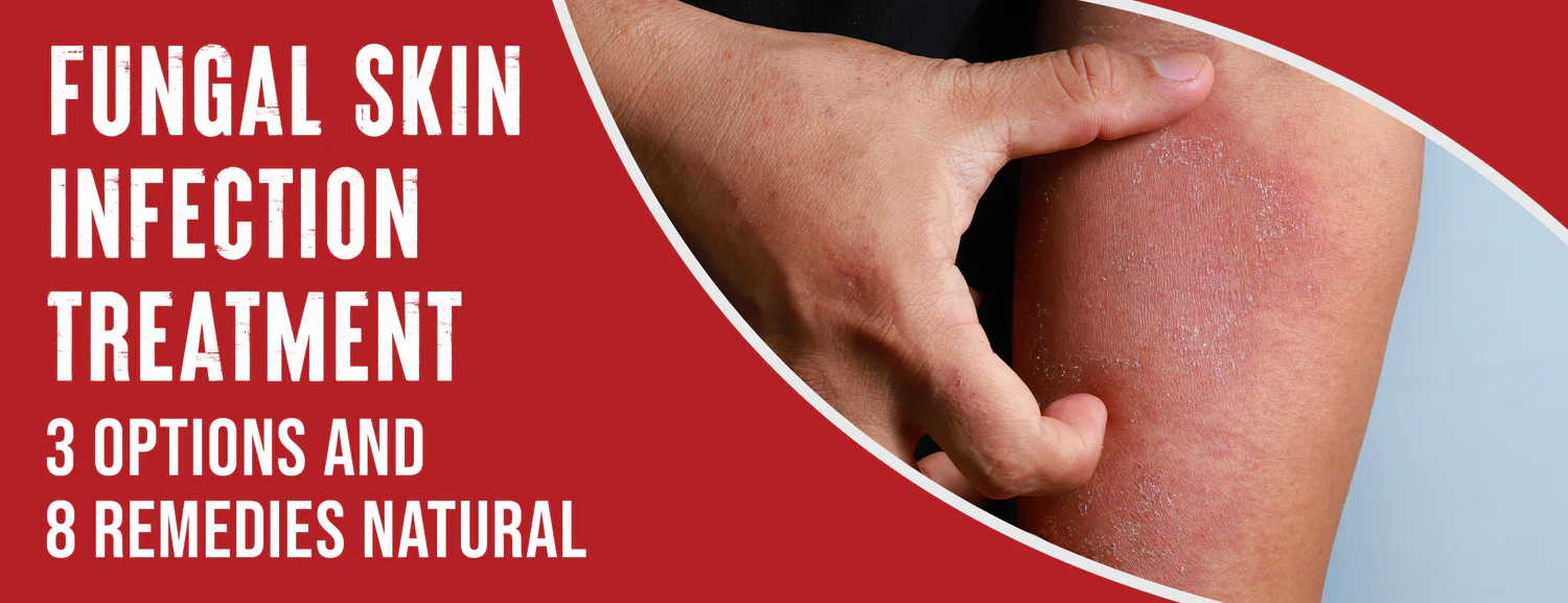 3 Best Methods for Treating Fungal Skin Infections