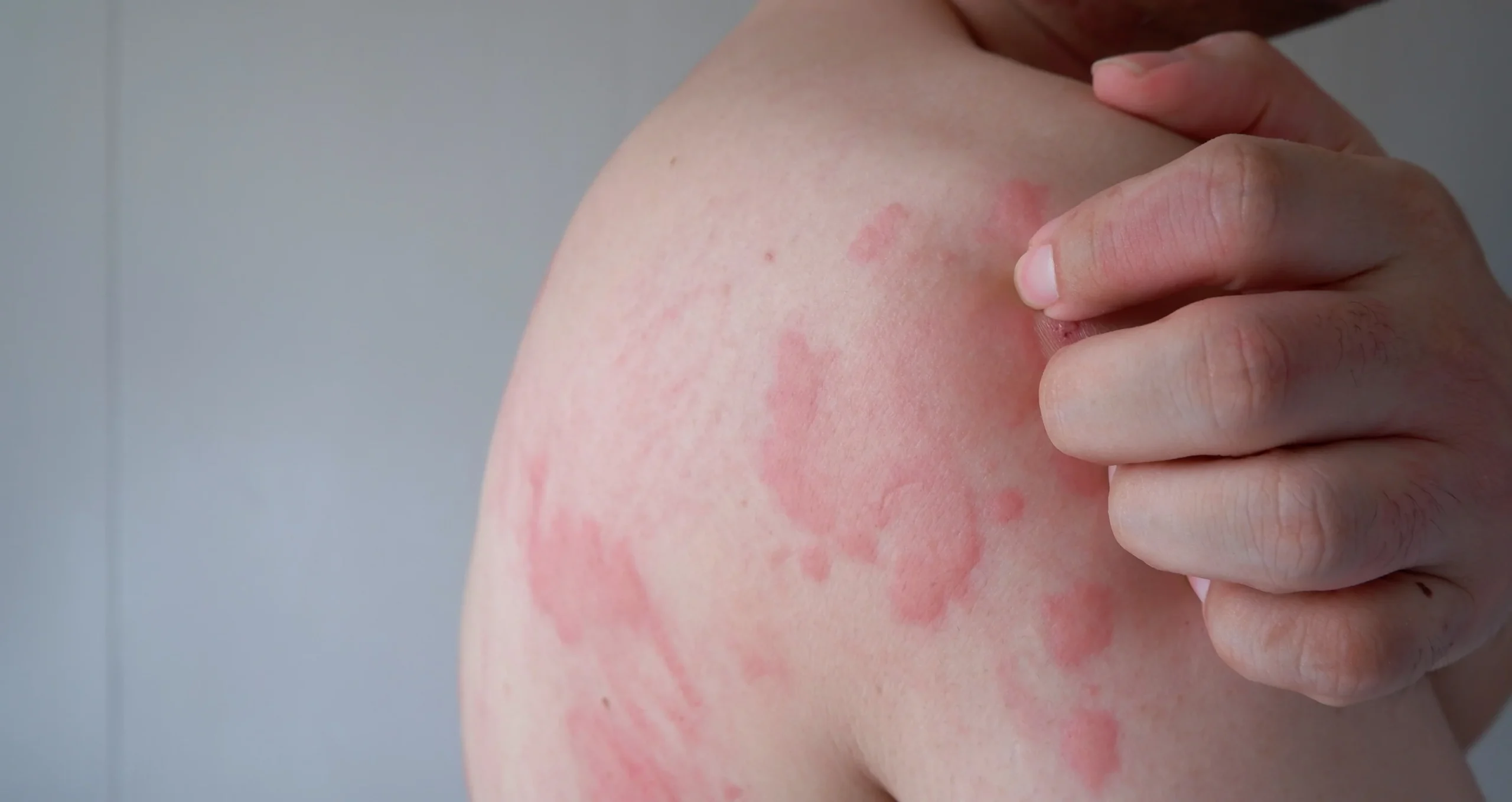 3 Effective Methods for Treating Sun Allergy Rash