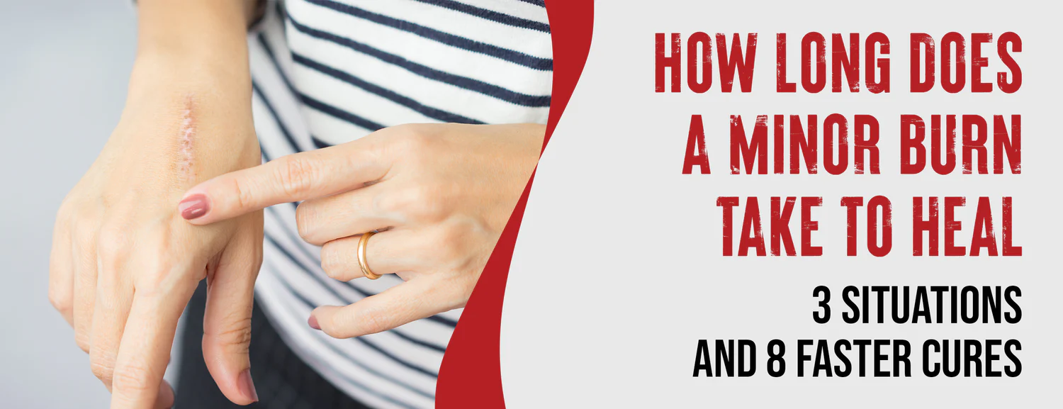 3 Factors Affecting Minor Burn Healing & 8 Fastest Ways