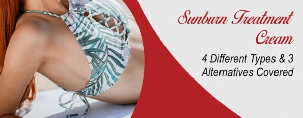 4 Different Sunburn Treatment Creams & 3 Alternatives