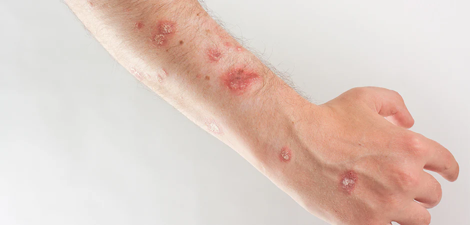 5 Initial Steps For Welding Burns