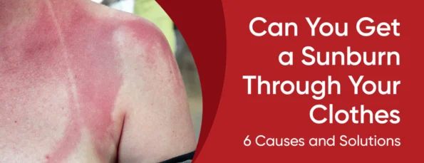 6 Causes of Sunburn Through Clothes With 5 Tips
