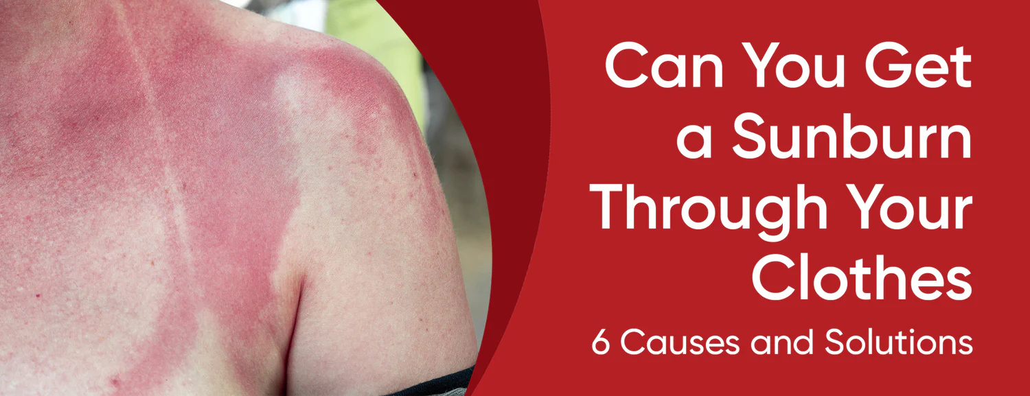 6 Causes of Sunburn Through Clothes With 5 Tips
