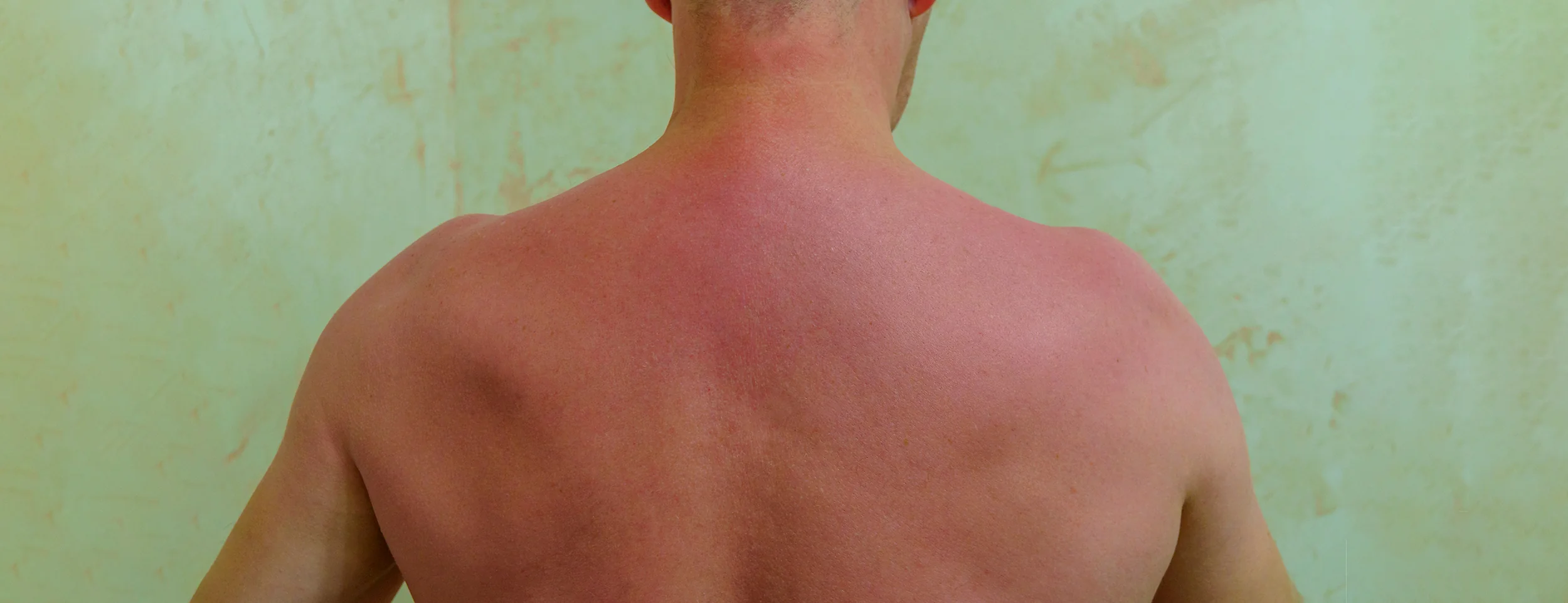 6 Reasons You Can Get a Sunburn Through Clothes