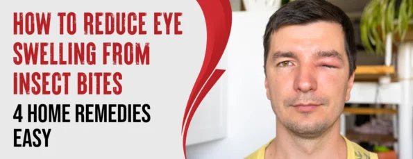8 Ways To Reduce Eye Swelling From Insect Bites
