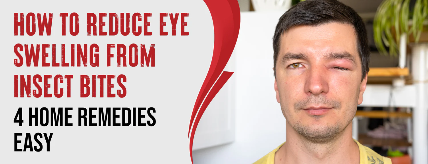 8 Ways To Reduce Eye Swelling From Insect Bites