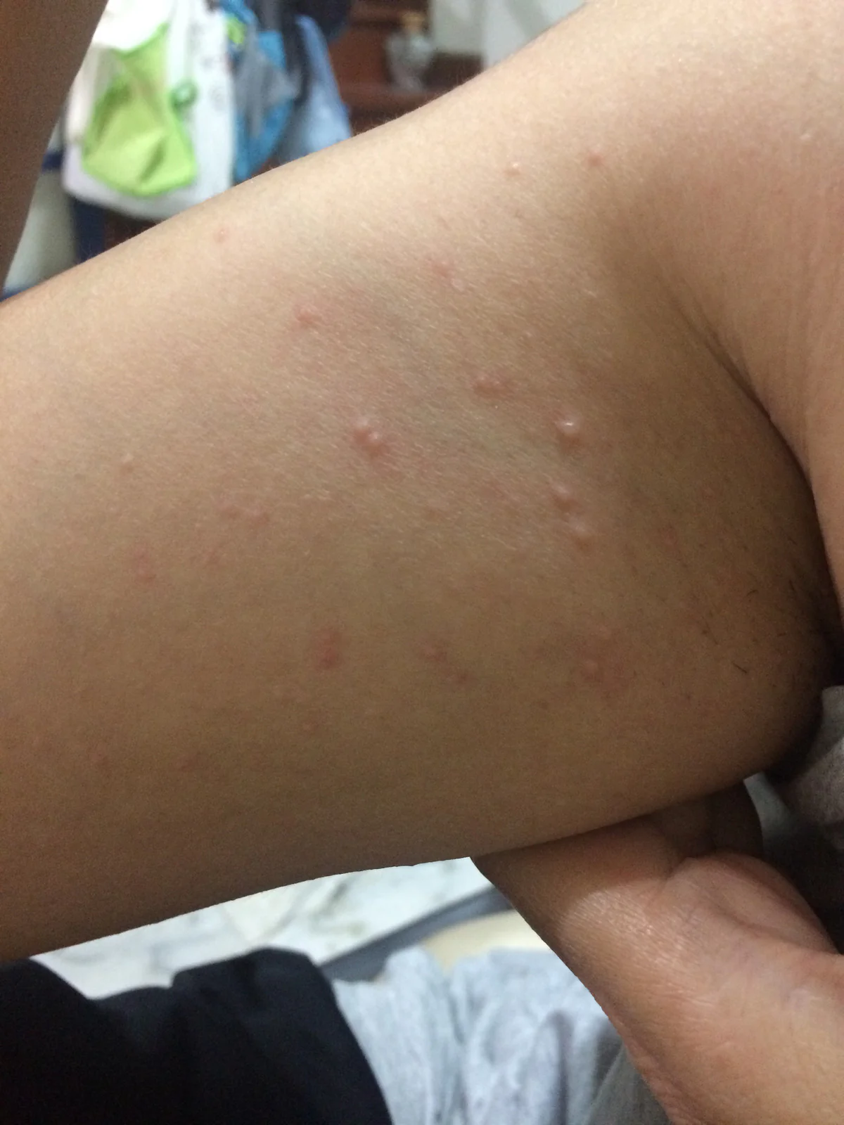 9 Natural Remedies For Fungal Skin Infections