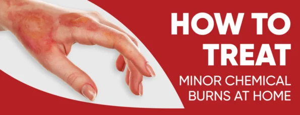A Guide To Treating Minor Chemical Burns At Home