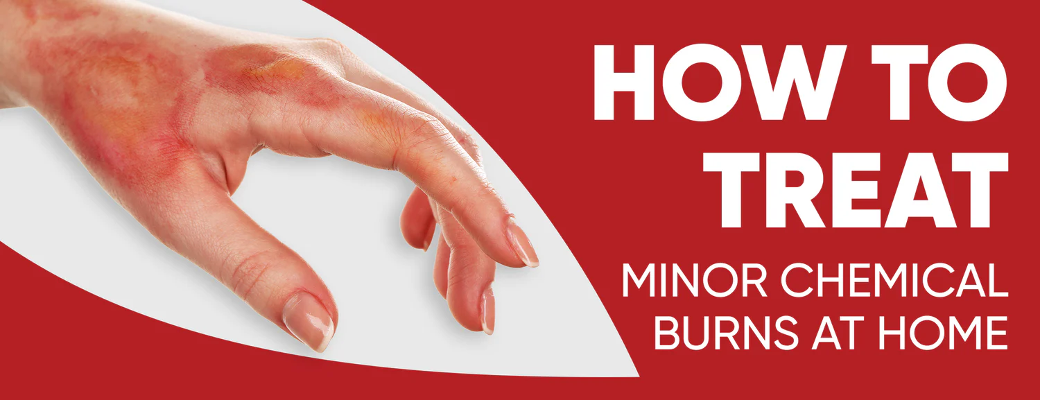 A Guide To Treating Minor Chemical Burns At Home