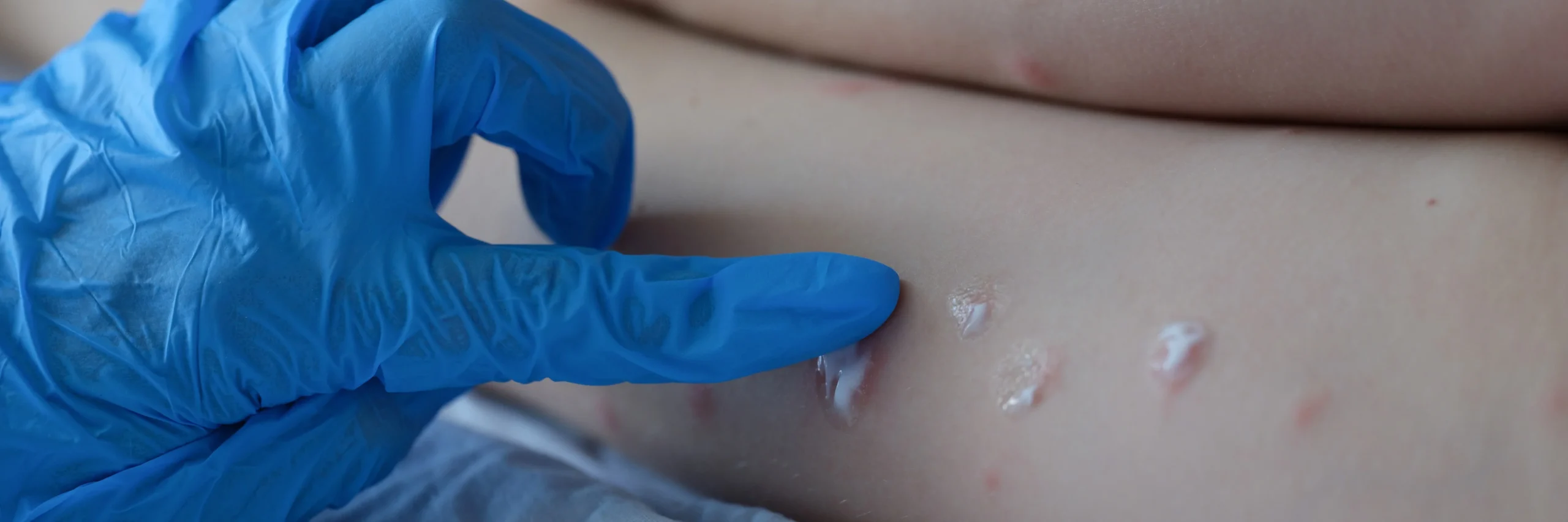 A Guide To Treating Painful Insect Bites