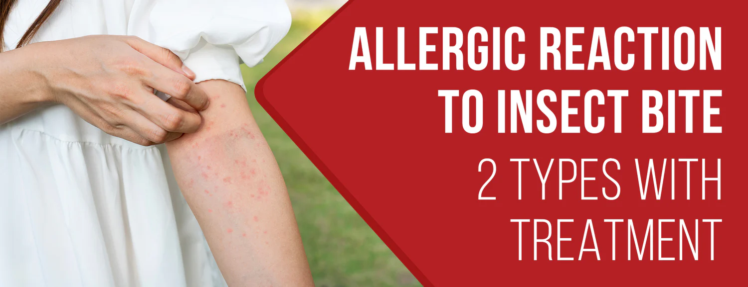 Allergies Types & Treatment Methods for Insect Bite