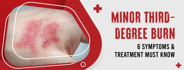 An injury of a third-degree burn of minor severity