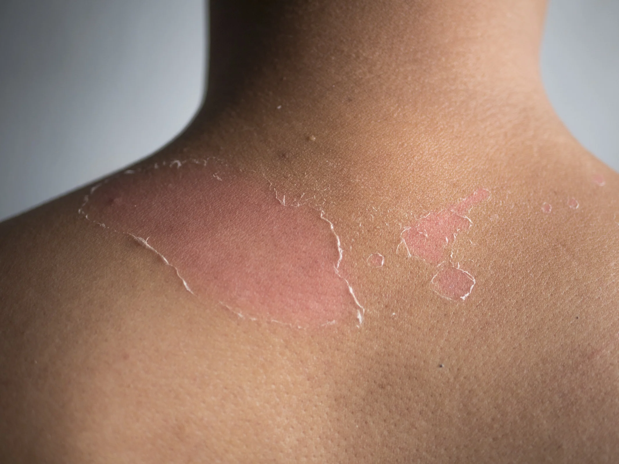 Avoid extreme sunburn when treating it