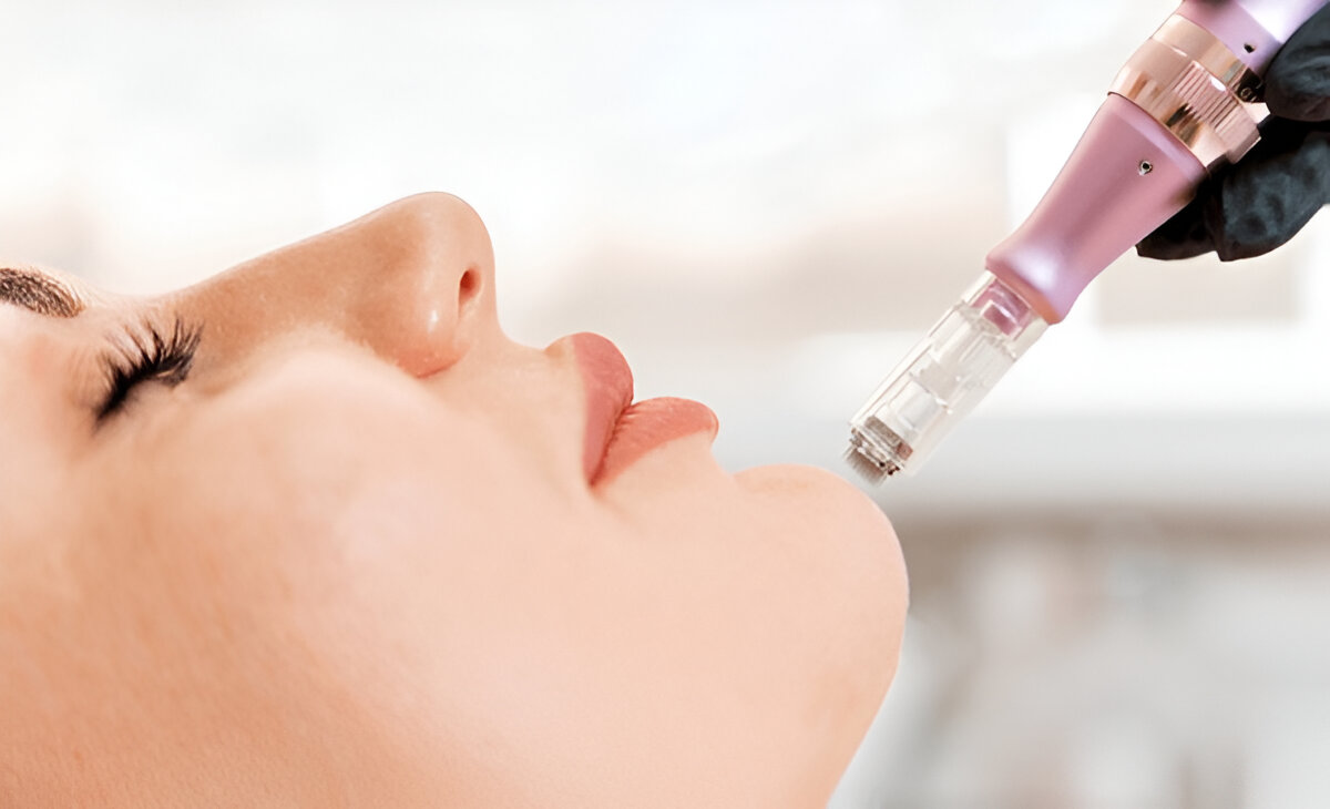 Benefits of Microneedling for Facial Treatment