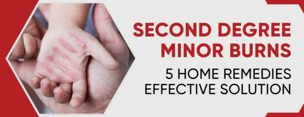 Burns of second degree, minor in severity