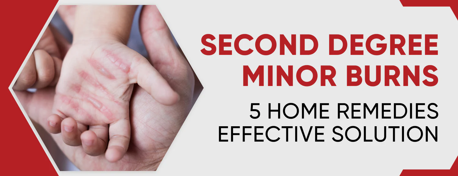 Burns of second degree, minor in severity