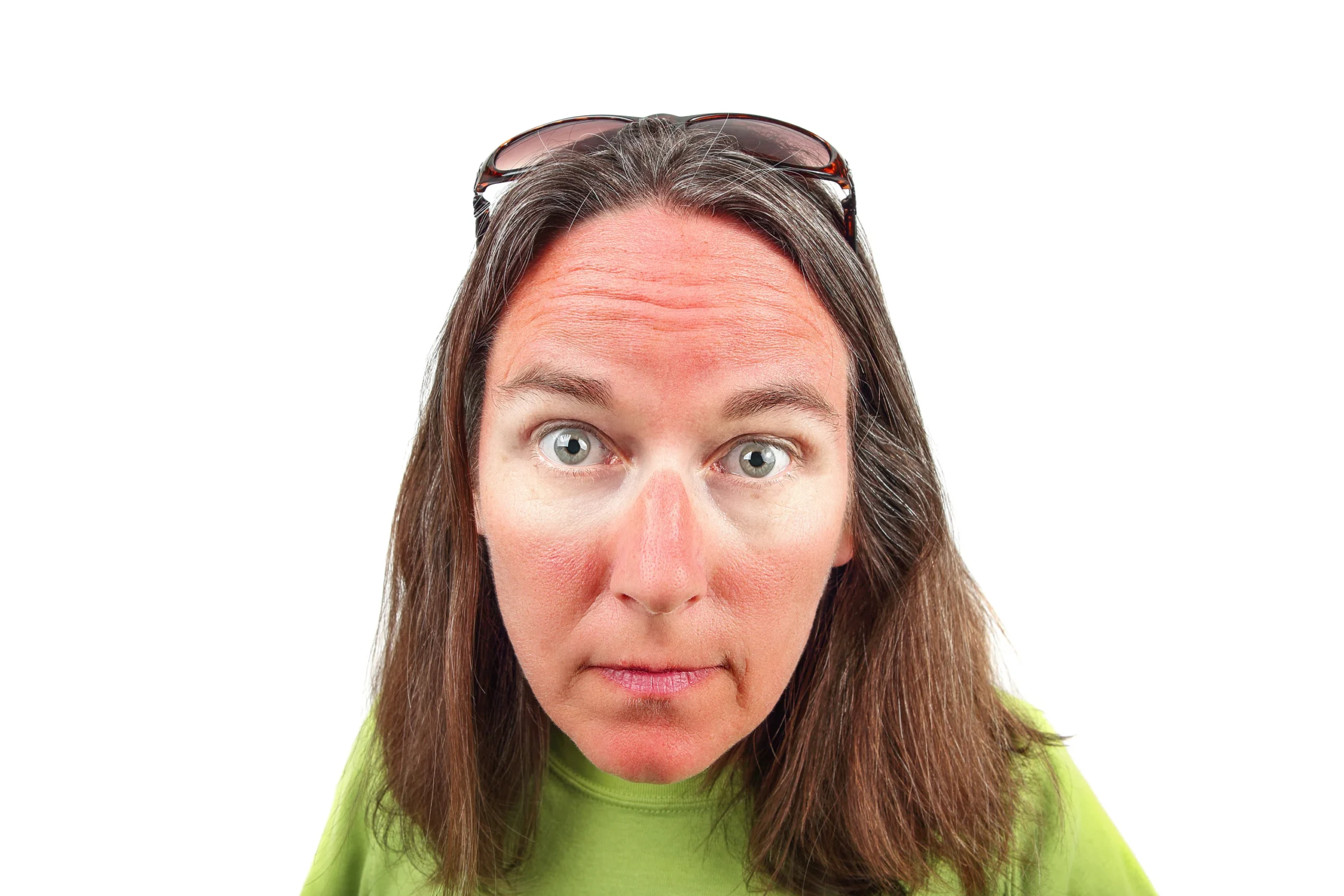 Causes of sunburned eyes