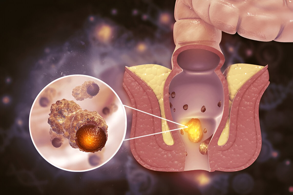 Comparison of Diagnostic Methods for Hemorrhoids And Cancer