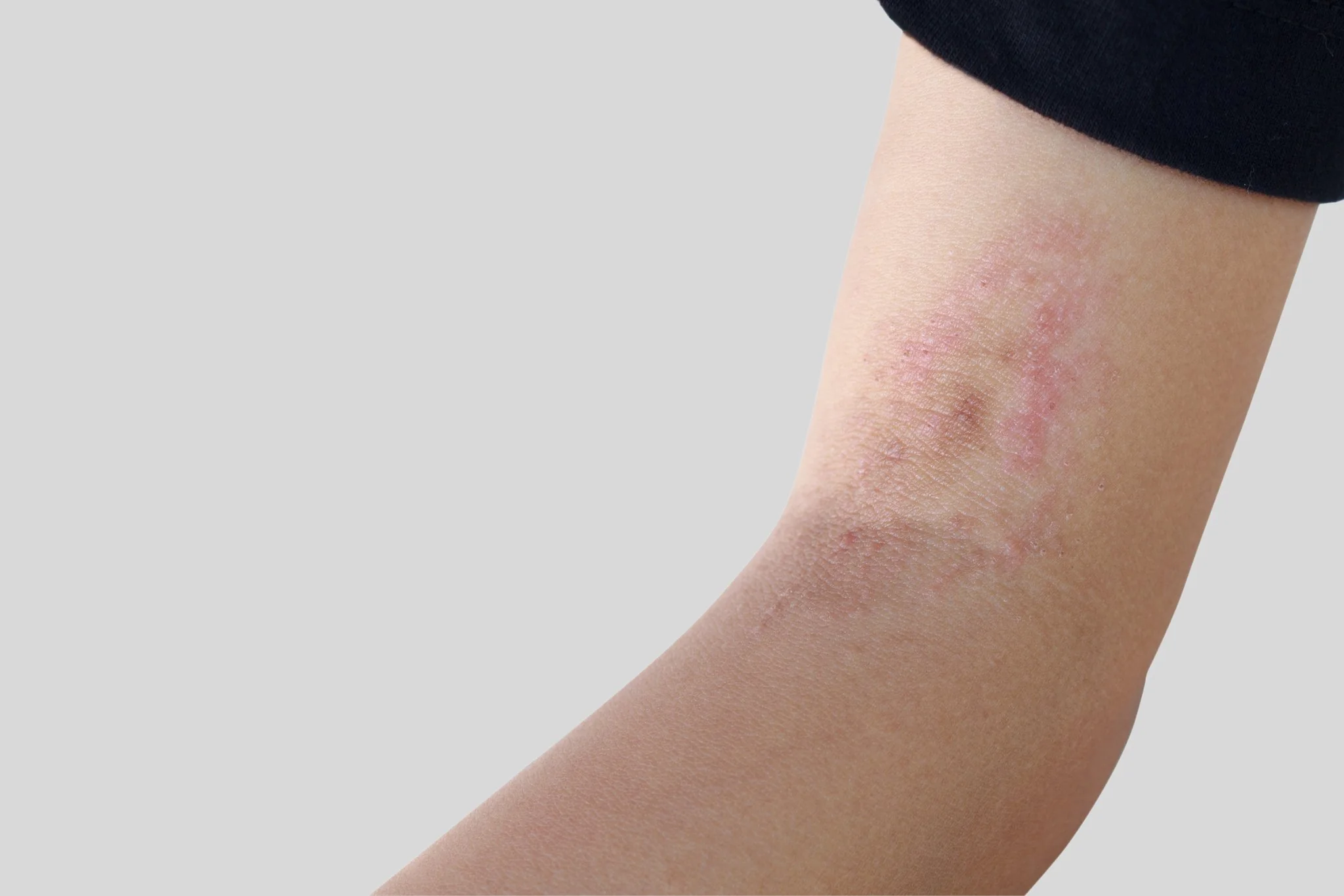 Fungal Skin Infection Treatment