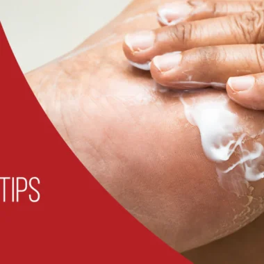 What To Do For Welding Burns on Skin | 8 Precautions