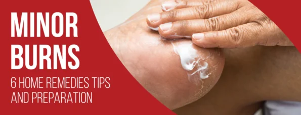 Home Remedies & Preparation Tips for Minor Burns