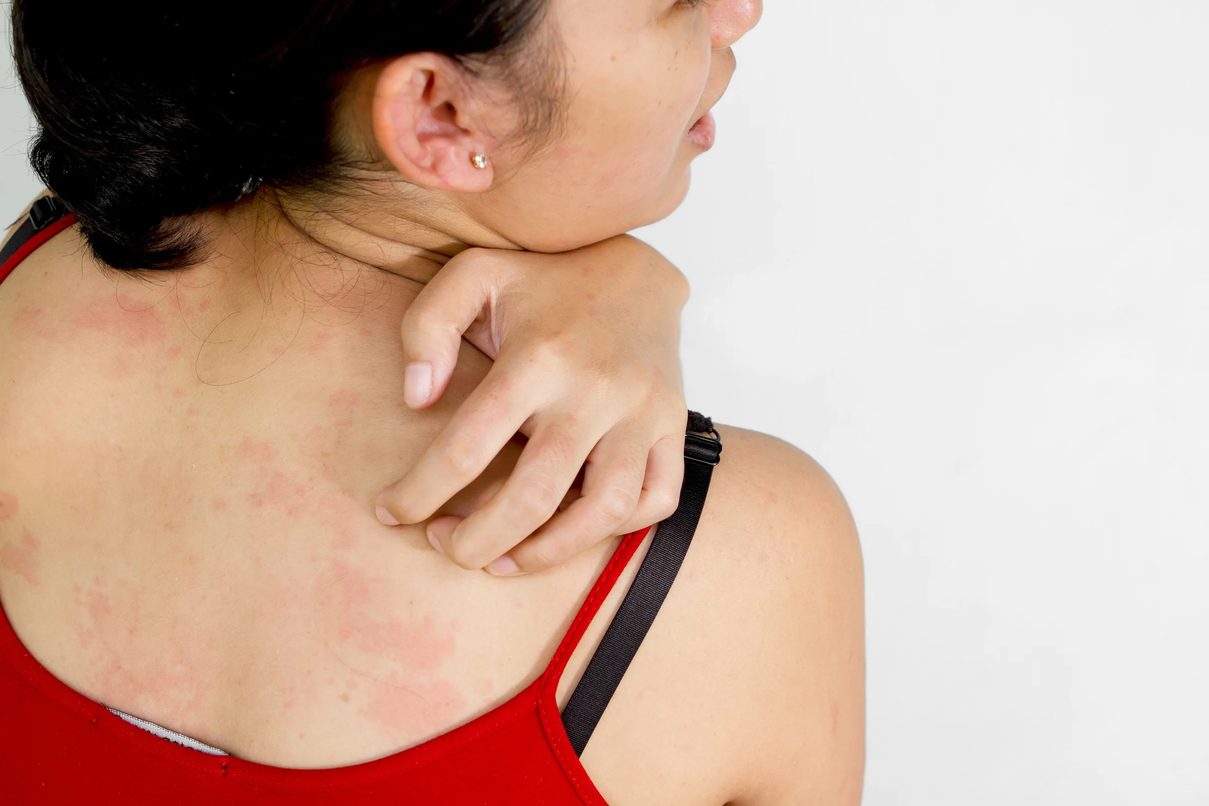 How To Cure Skin Allergy 5 Best Ways