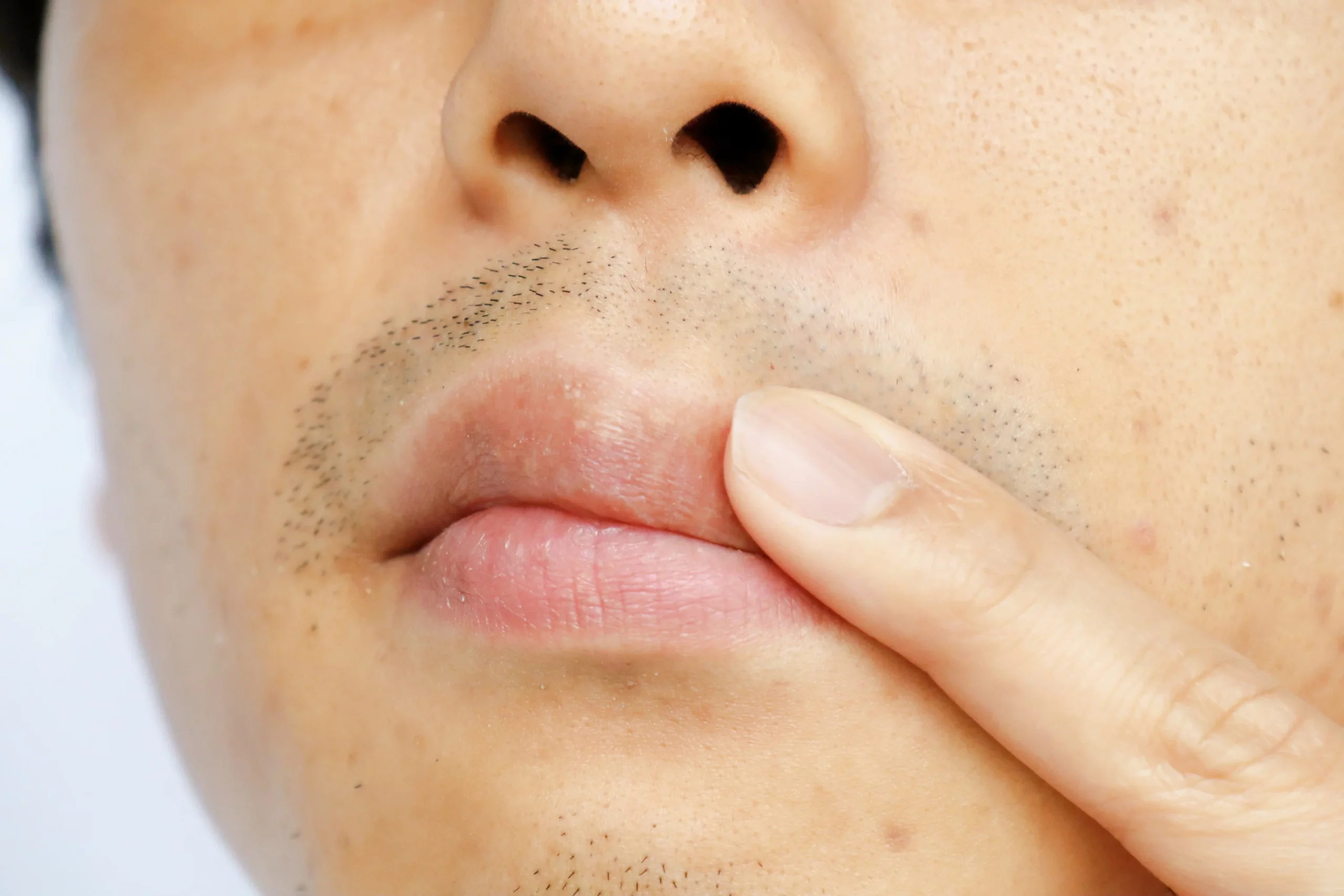Irritation and redness caused by electrolysis hair removal for men