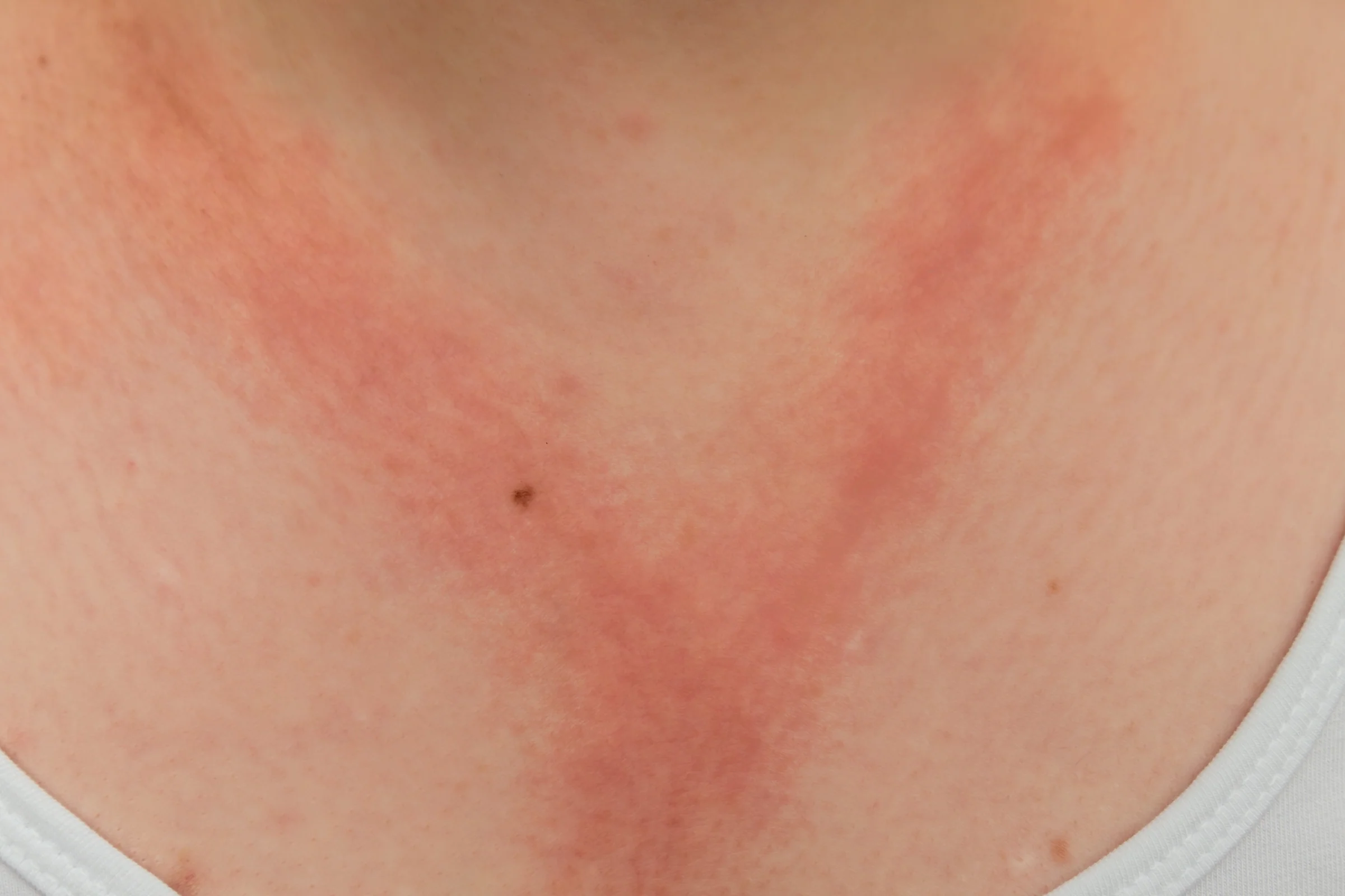 Irritation from allergies and specific allergens