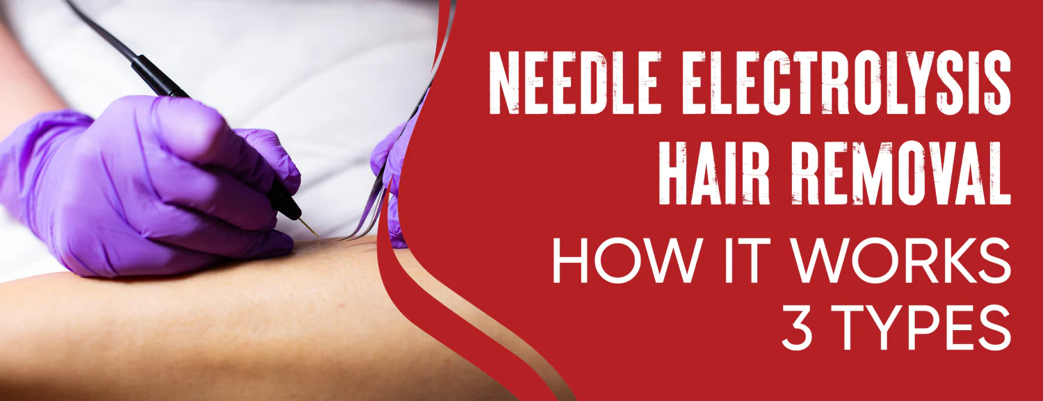 Laser Hair Removal Using Needle Electrolysis