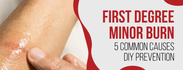 Minor burns of the first degree