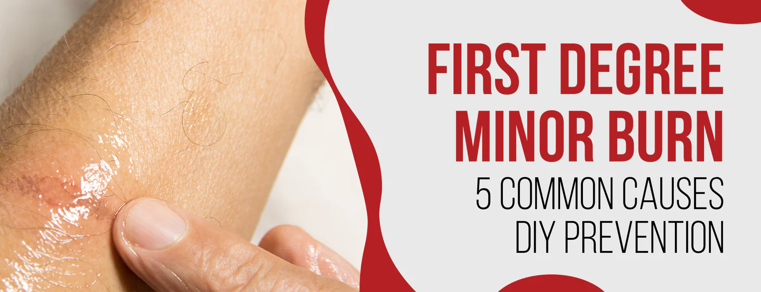 Minor burns of the first degree