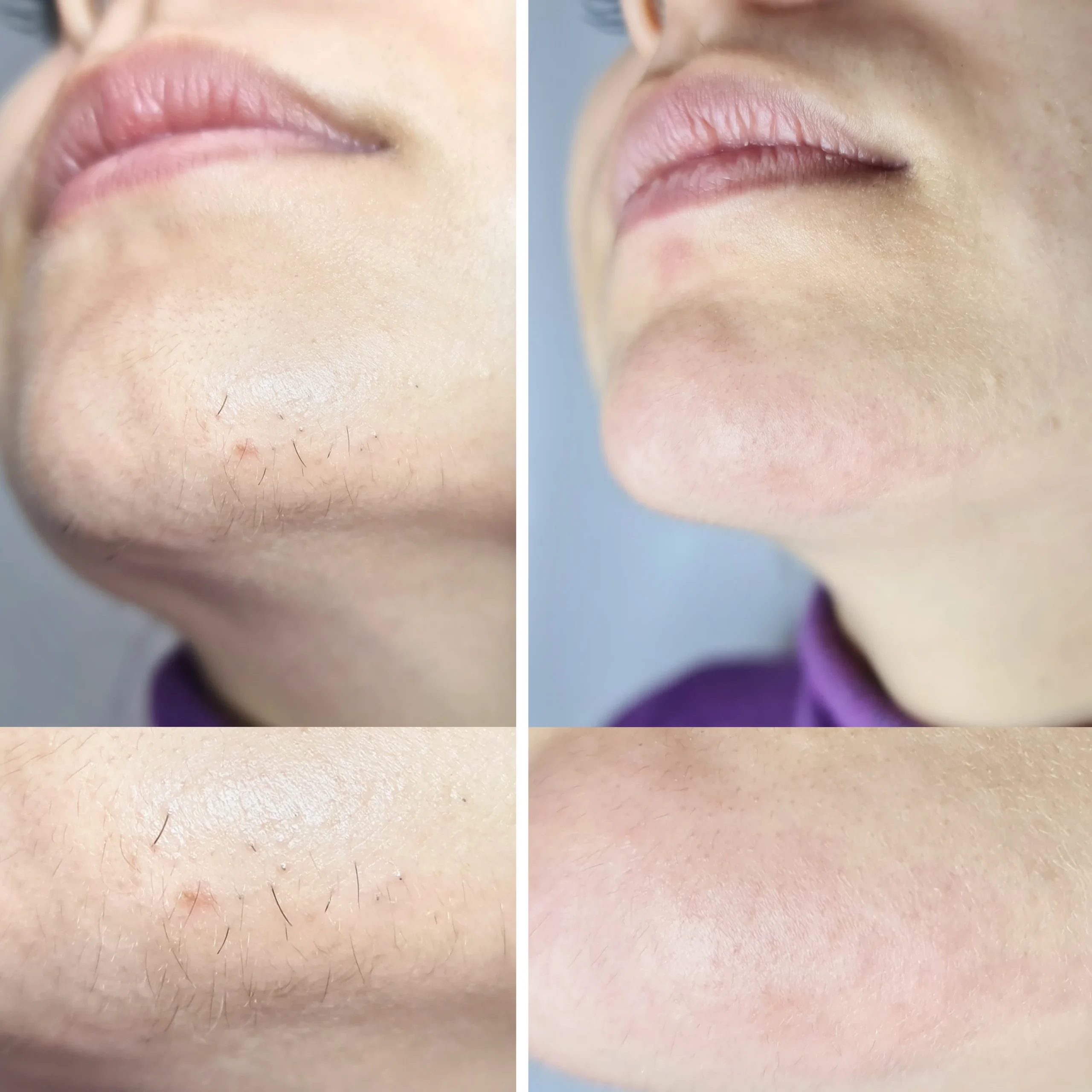 Multiple hair follicles are targeted by electrolysis for coarse chin hair