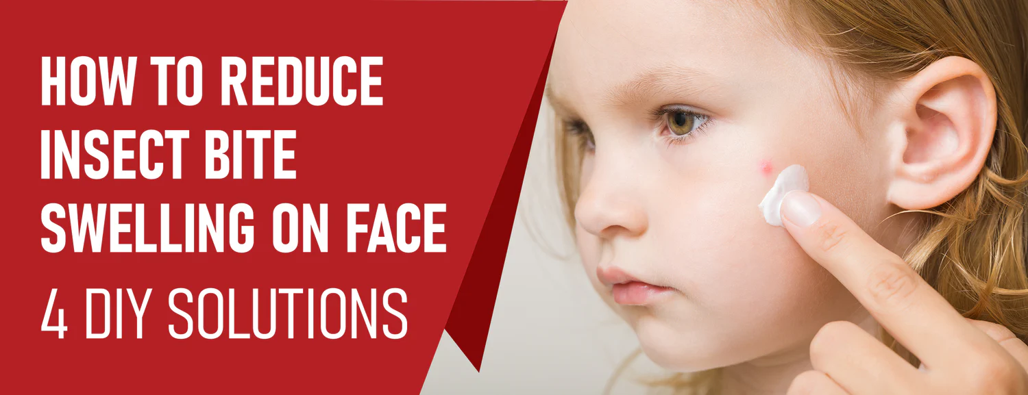 Preventing and treating insect bite swelling on your face