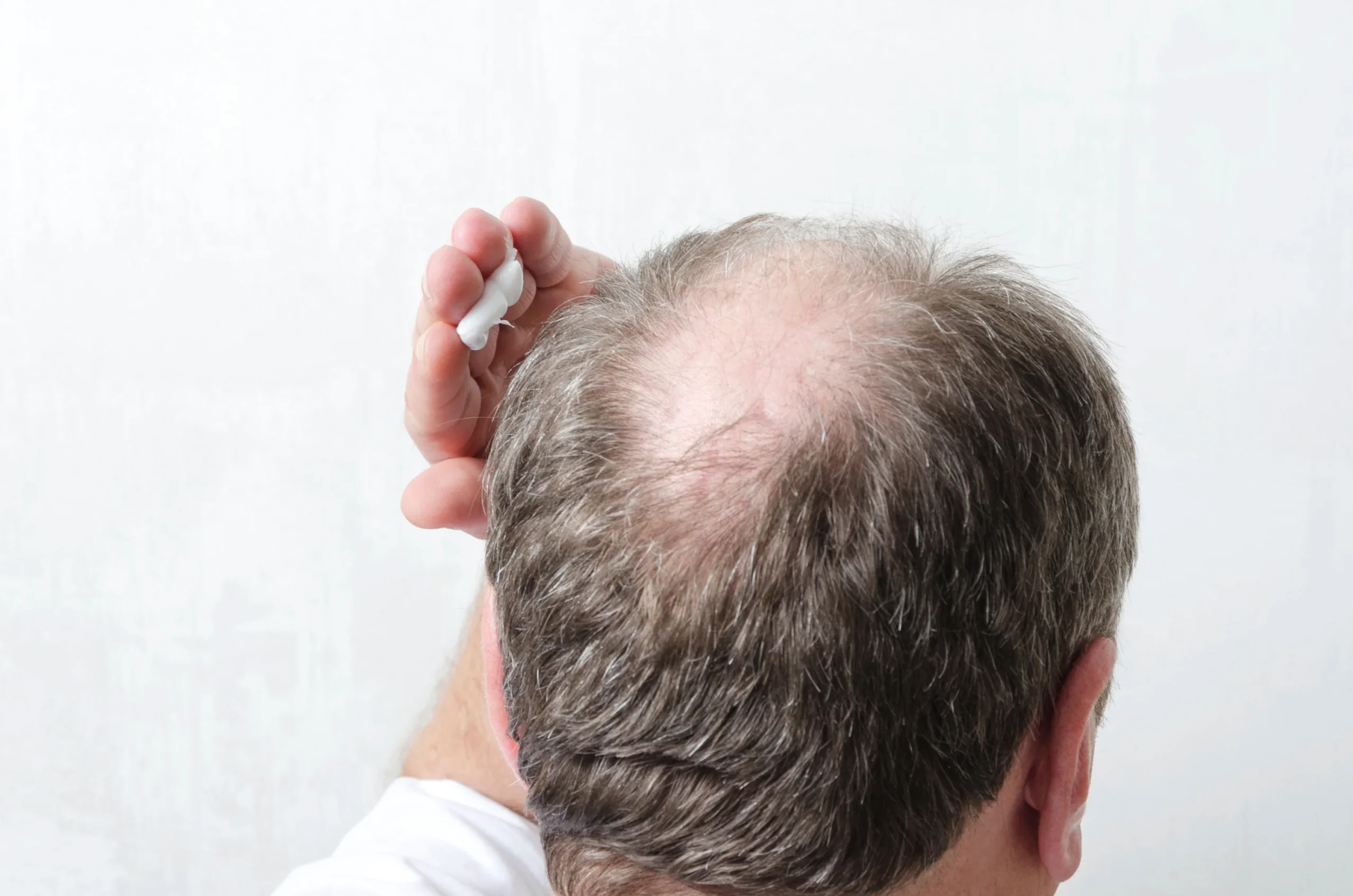 Relief from Sunburned Scalp Pain Over-the-Counter