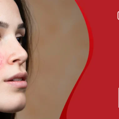 Home Remedies for Treating Pruritus Ani: 9 Tips