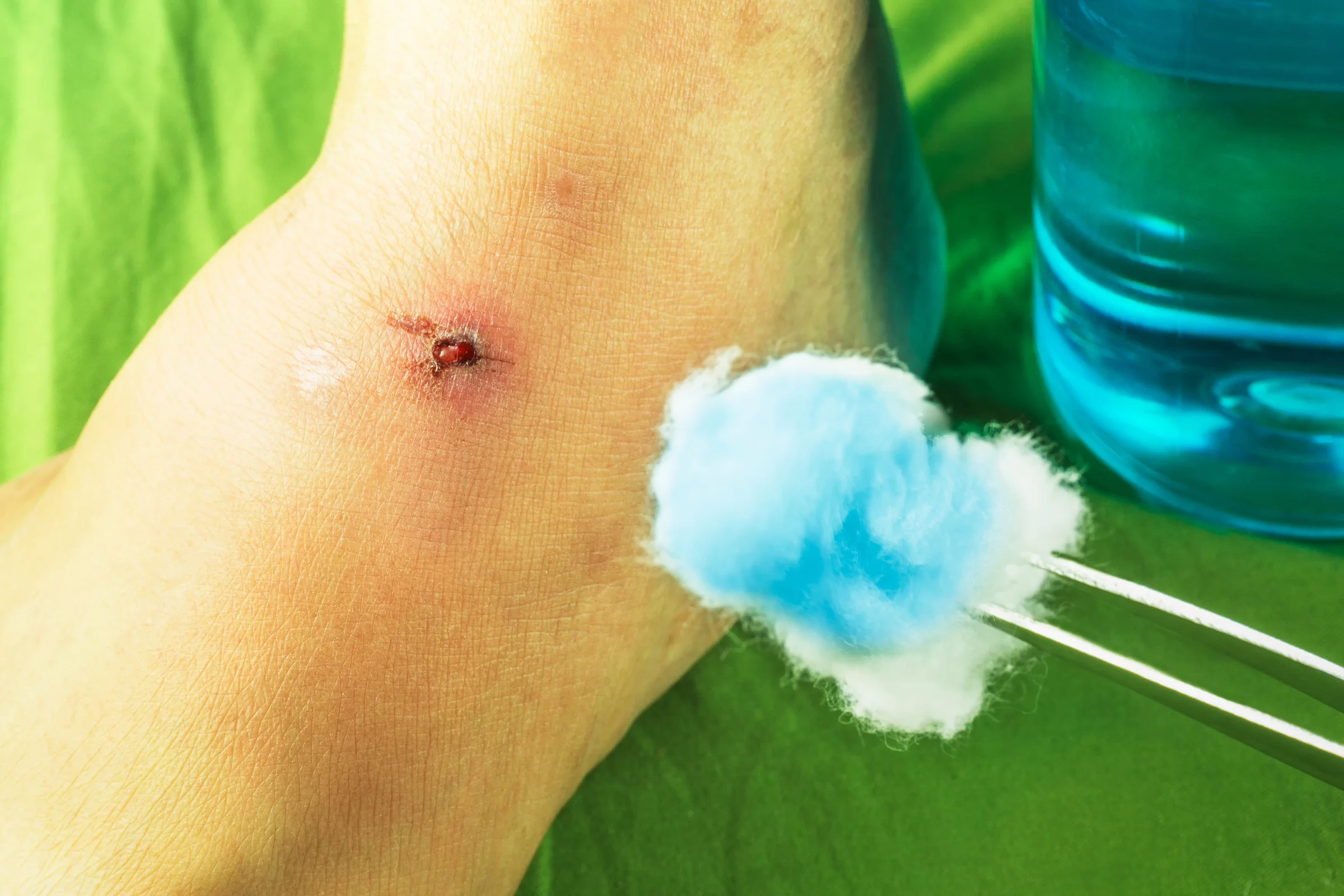 Rubbing alcohol is a not good disinfectant for open wounds