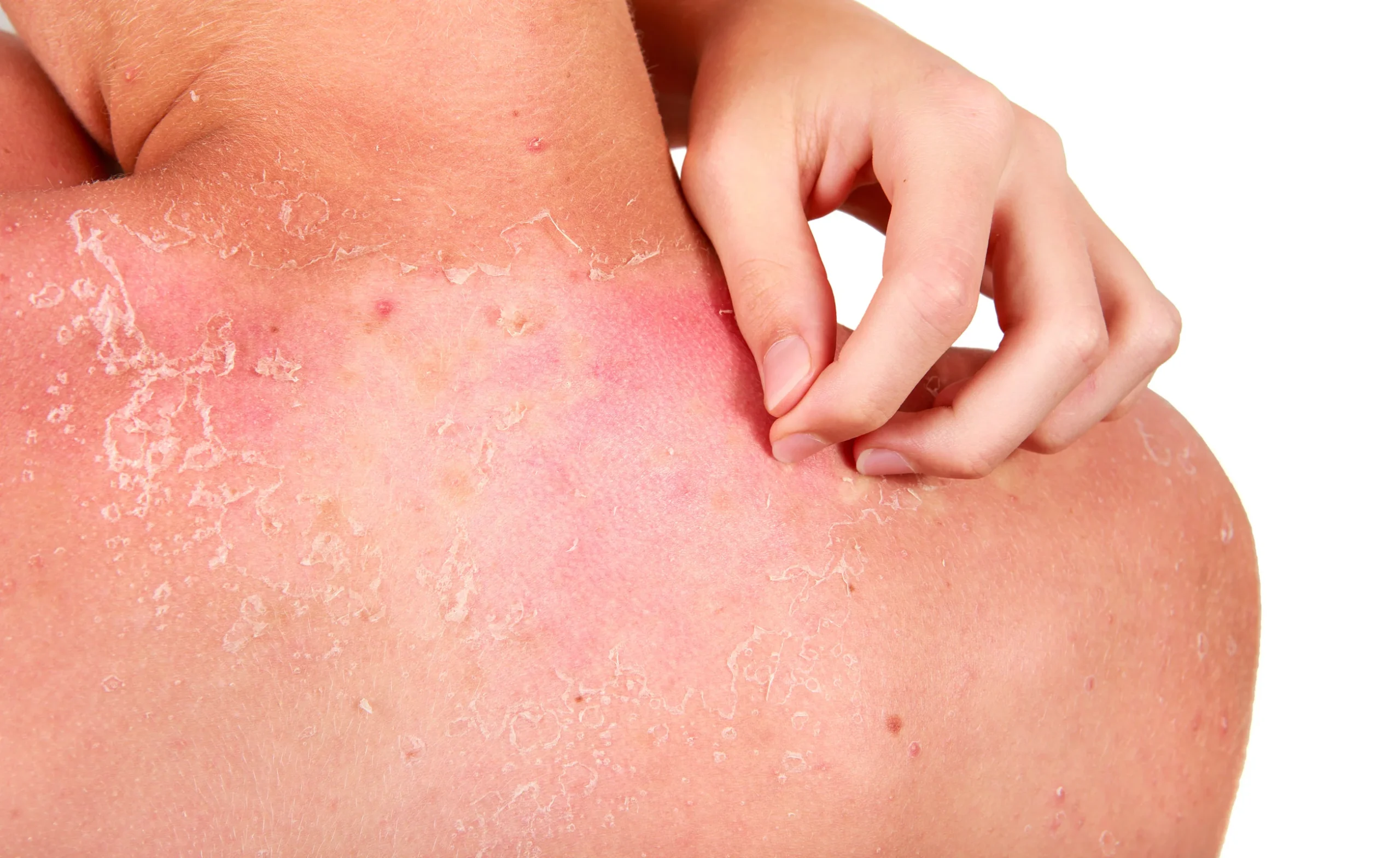 Sunburn Symptoms You Should See from Infected Sunburns