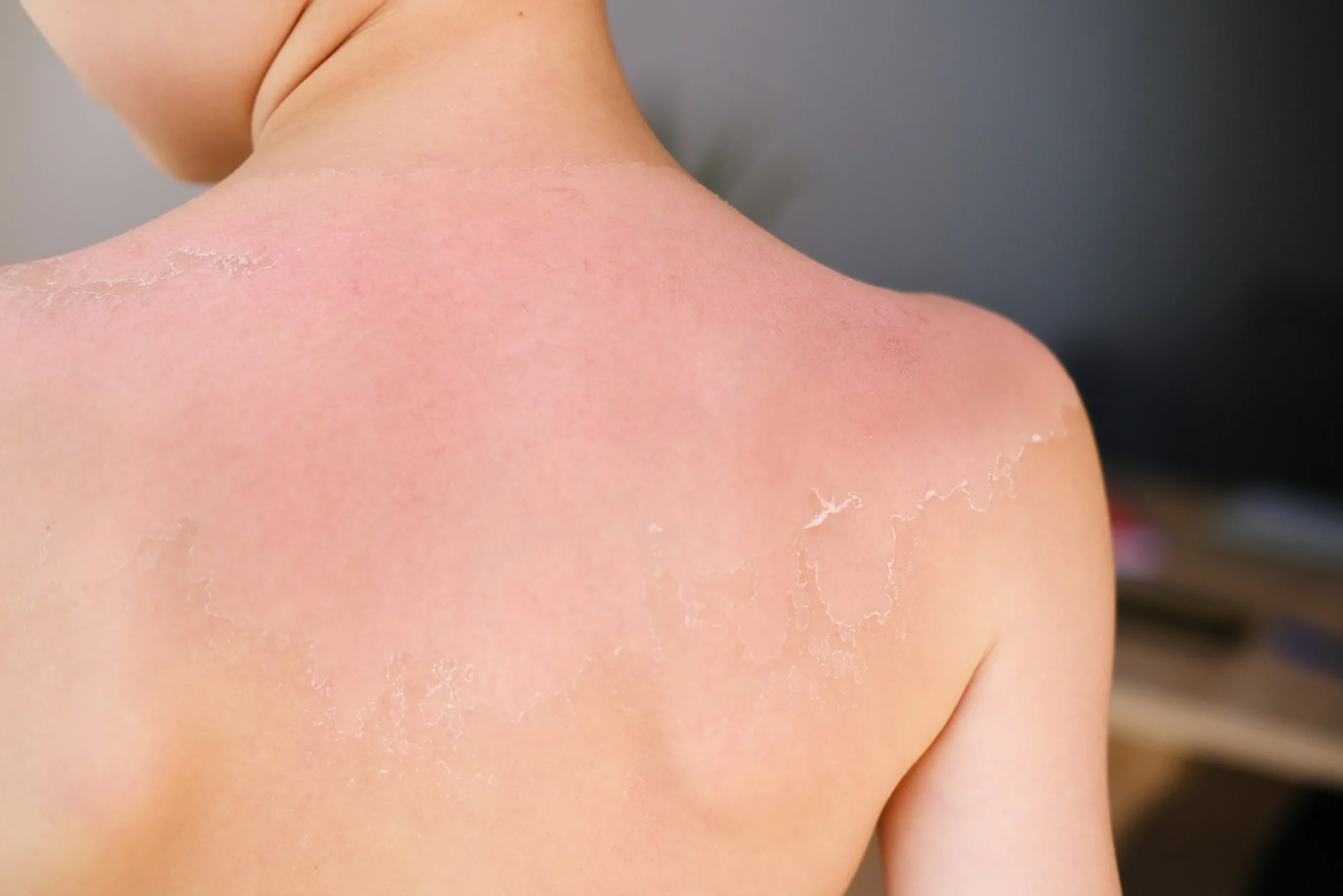 Sunburn emergencies for babies