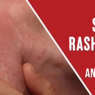 Most Painful Insect Bites: 10 Types [How to Avoid Them]