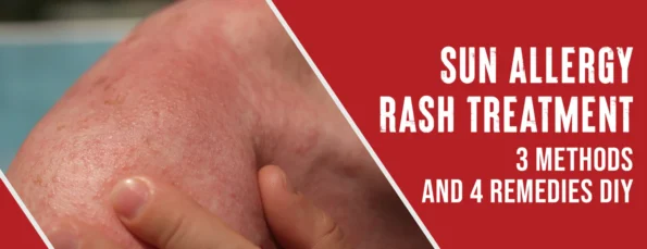 The 3 Best Methods for Treating Sun Allergy Rash