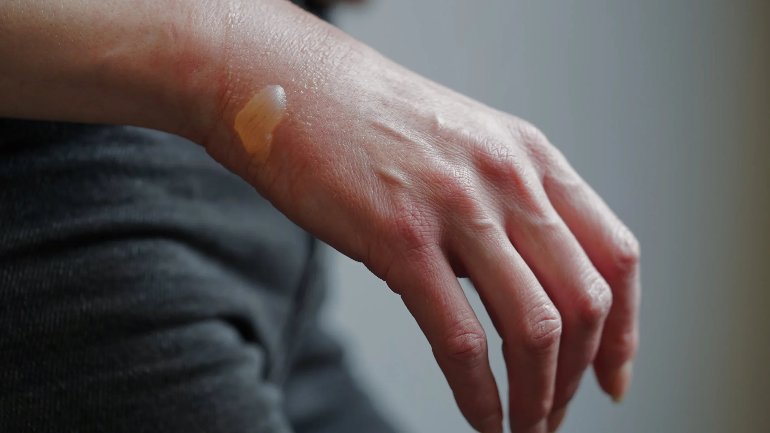 The 3 Factors Affecting the Time it Takes to Heal a Minor Burn