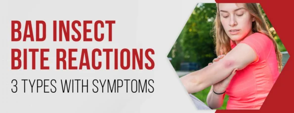 The 3 Types of Bad Insect Bite Reactions With Symptoms