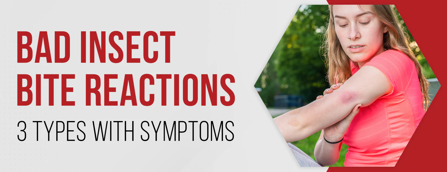 The 3 Types of Bad Insect Bite Reactions With Symptoms