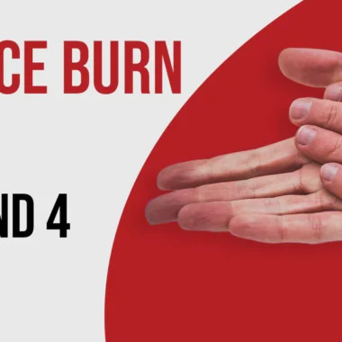 What To Do For Welding Burns on Skin | 8 Precautions