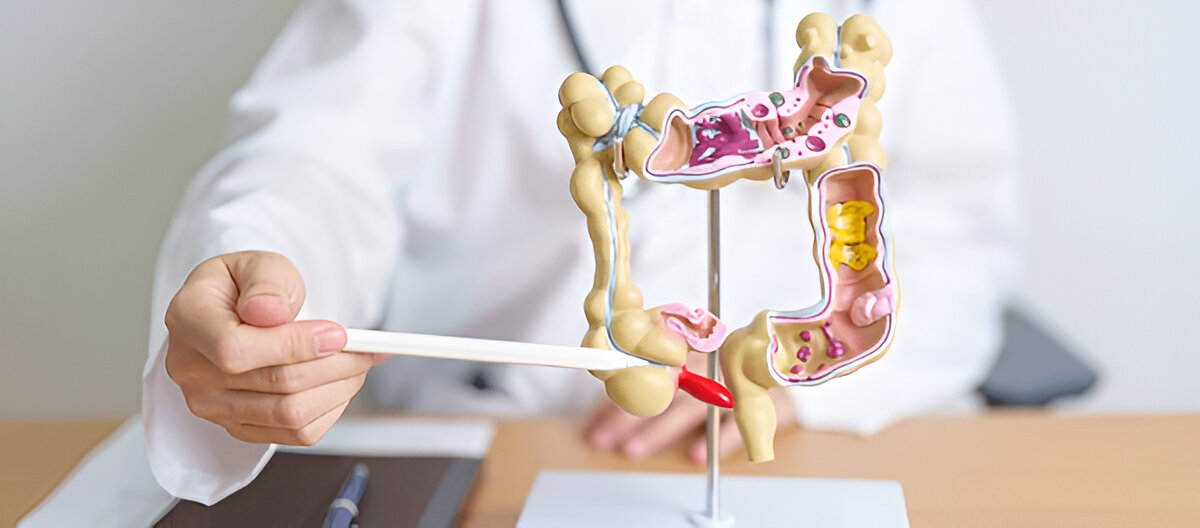 The causes of colorectal cancer