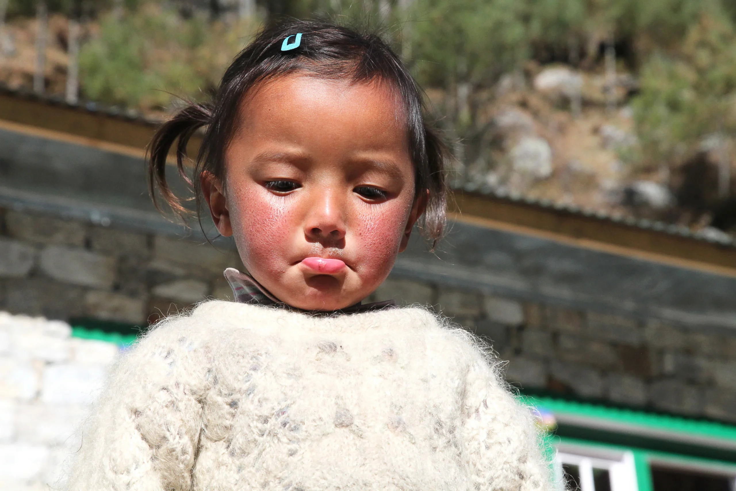 The causes of sunburn in babies