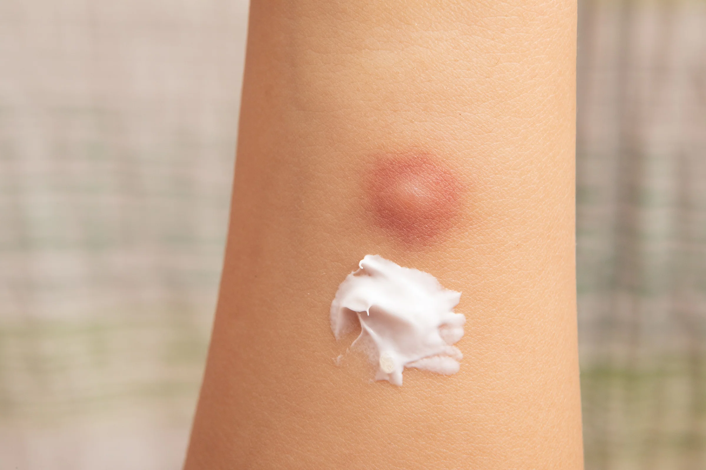 There are 6 effective treatments for fever caused by insect bites